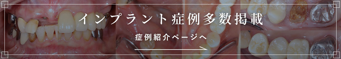 インプラント症例紹介