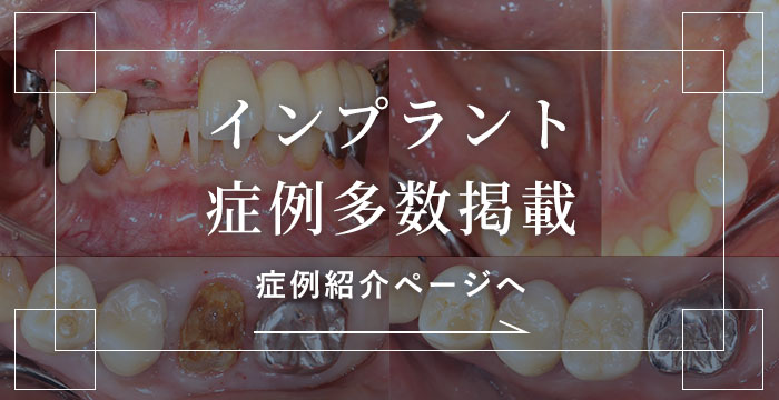 インプラント症例紹介