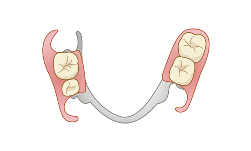 部分入れ歯（部分義歯）