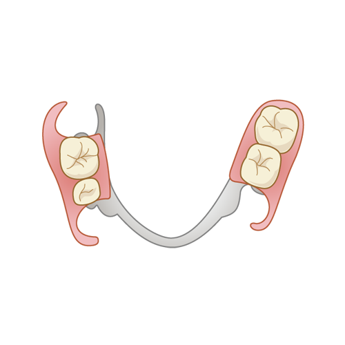 部分入れ歯（部分義歯）