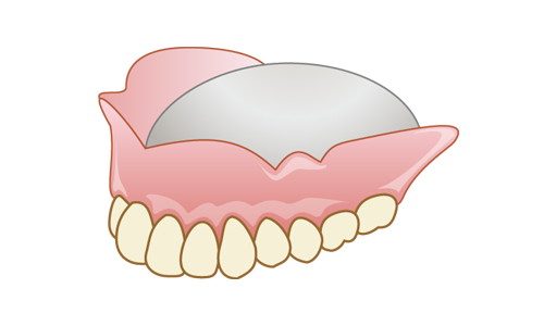金属床義歯（自費診療）