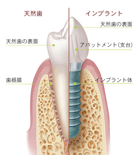 インプラントについて